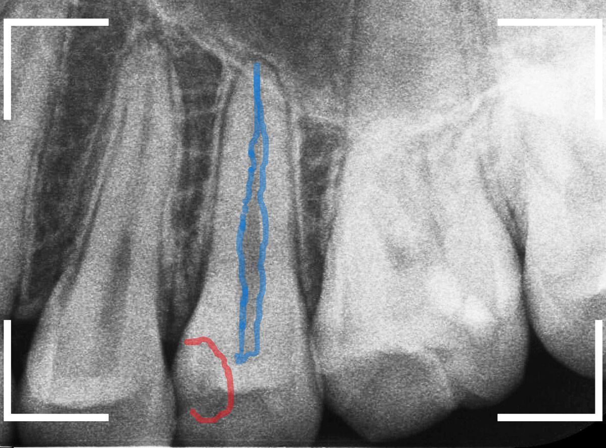 歯と歯の間の虫歯15-2