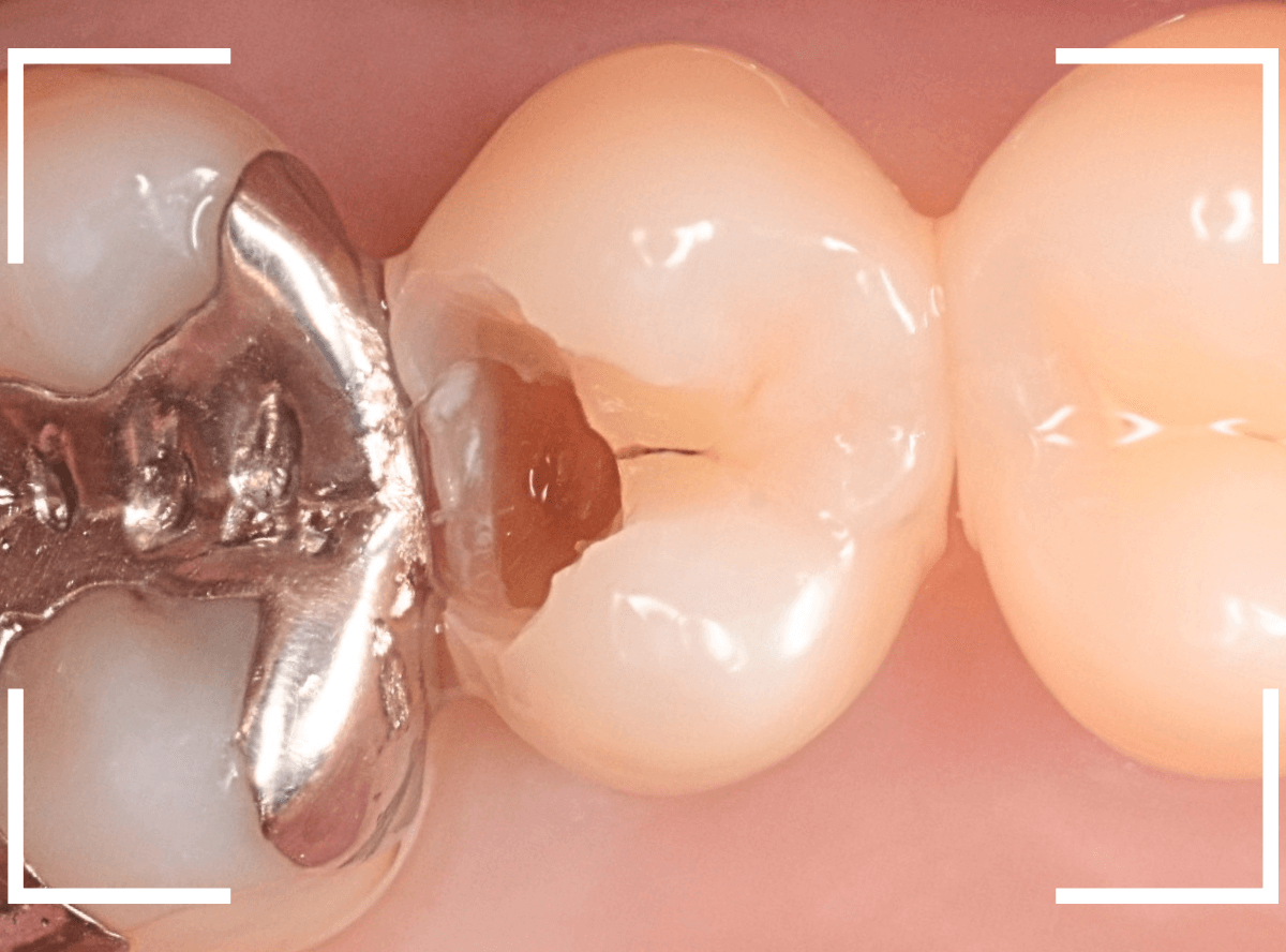 歯と歯の間の虫歯10-4