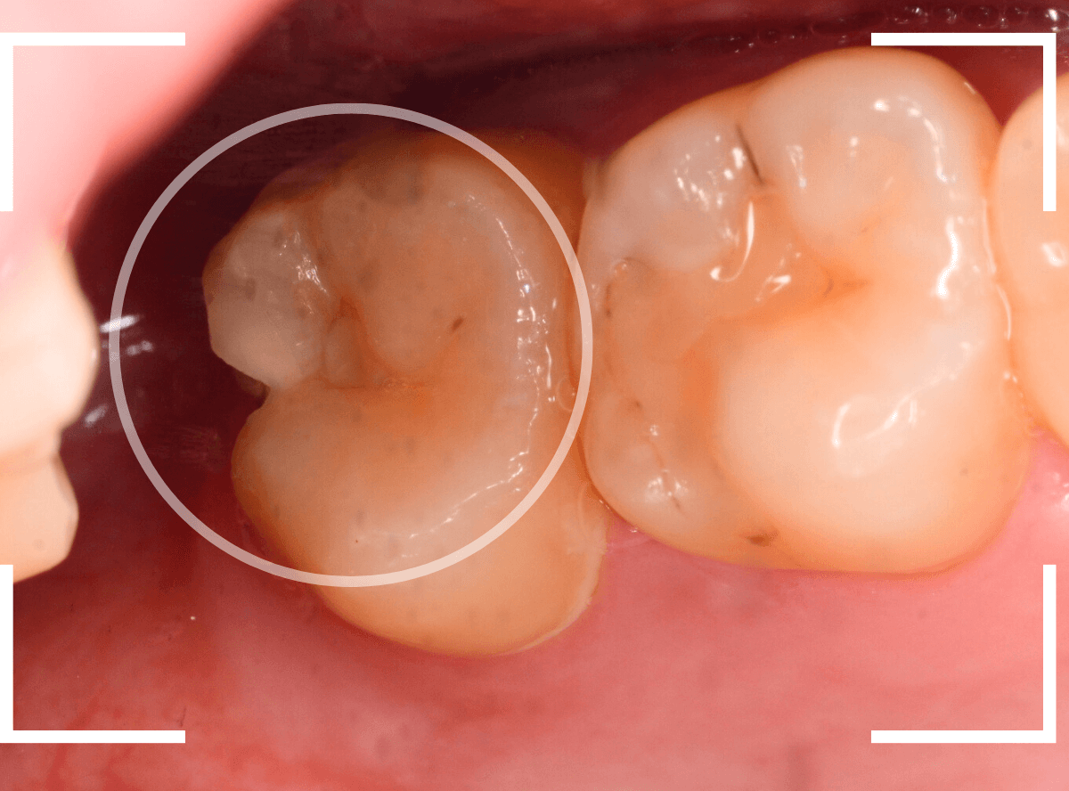 気づかないうちに深い虫歯3-1
