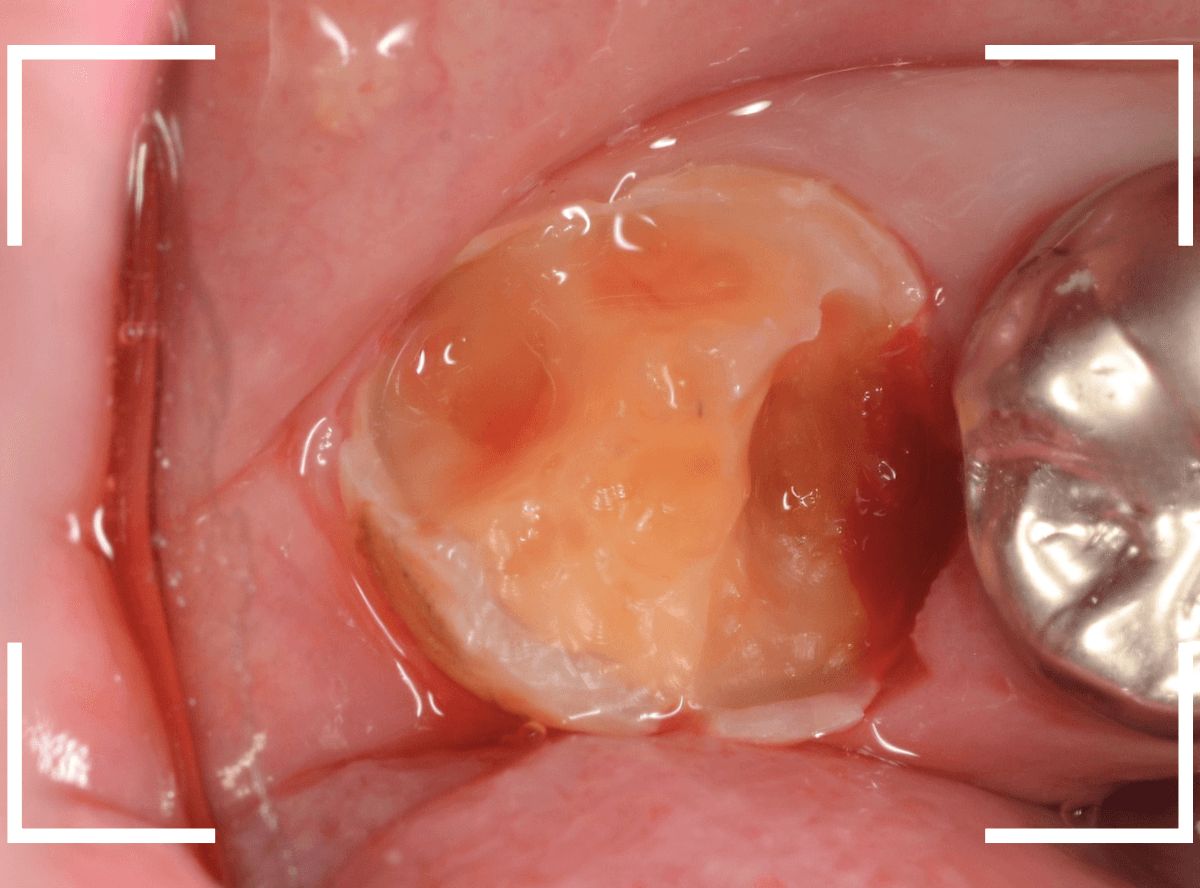 気づかないうちに深い虫歯14-5