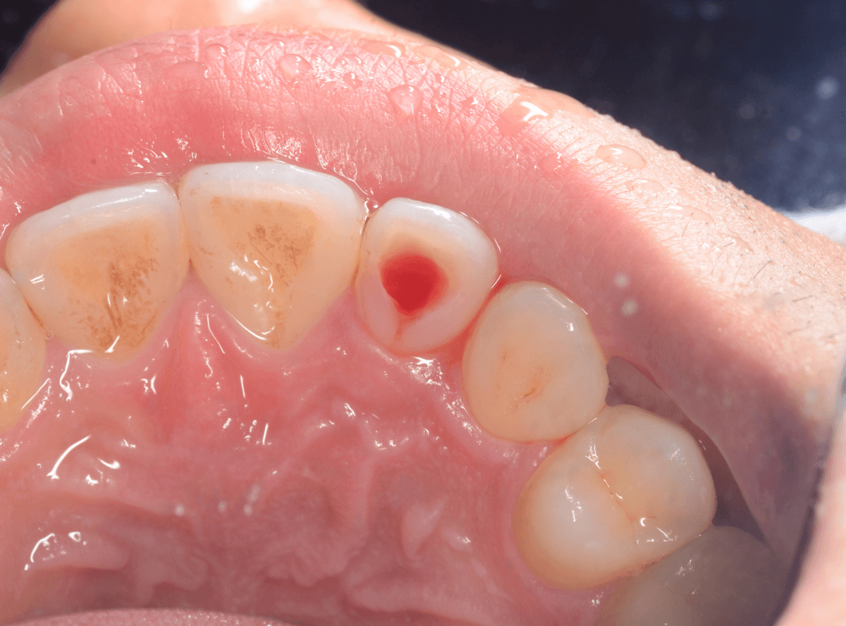 虫歯じゃないけど、歯がとても痛くて眠れない(画像)-3