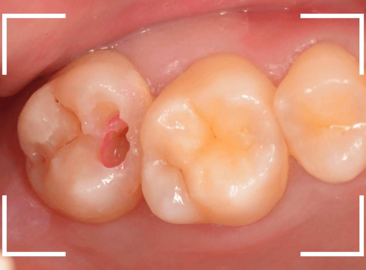 歯と歯の間の虫歯20-3