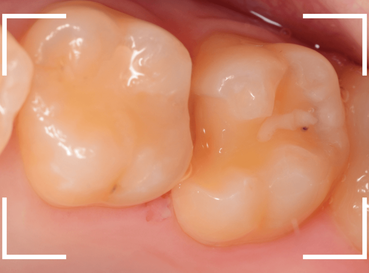 セラミック治療(インレー)29-2