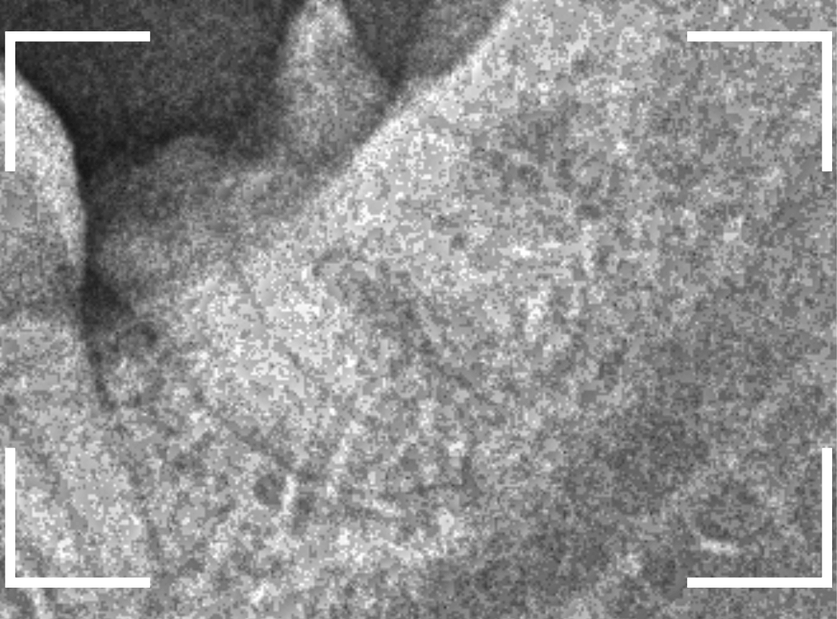 おやしらずの抜歯12-2