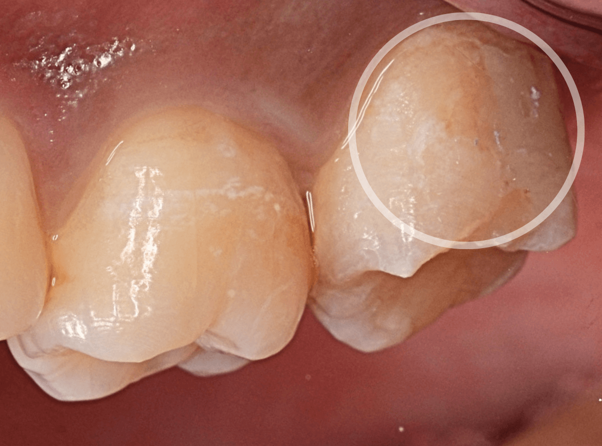 知覚過敏の画像2-2