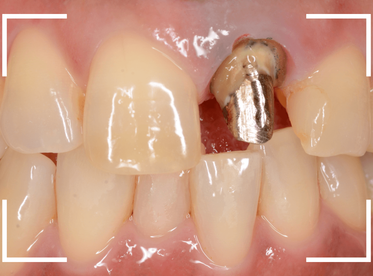 セラミック治療(前歯・クラウン)3-4