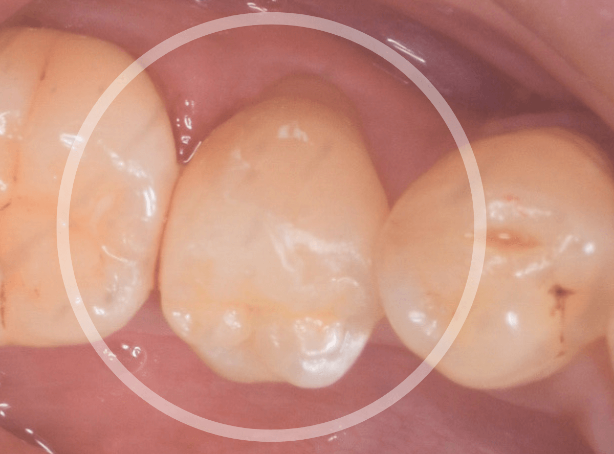 セラミック治療(インレー)1-2