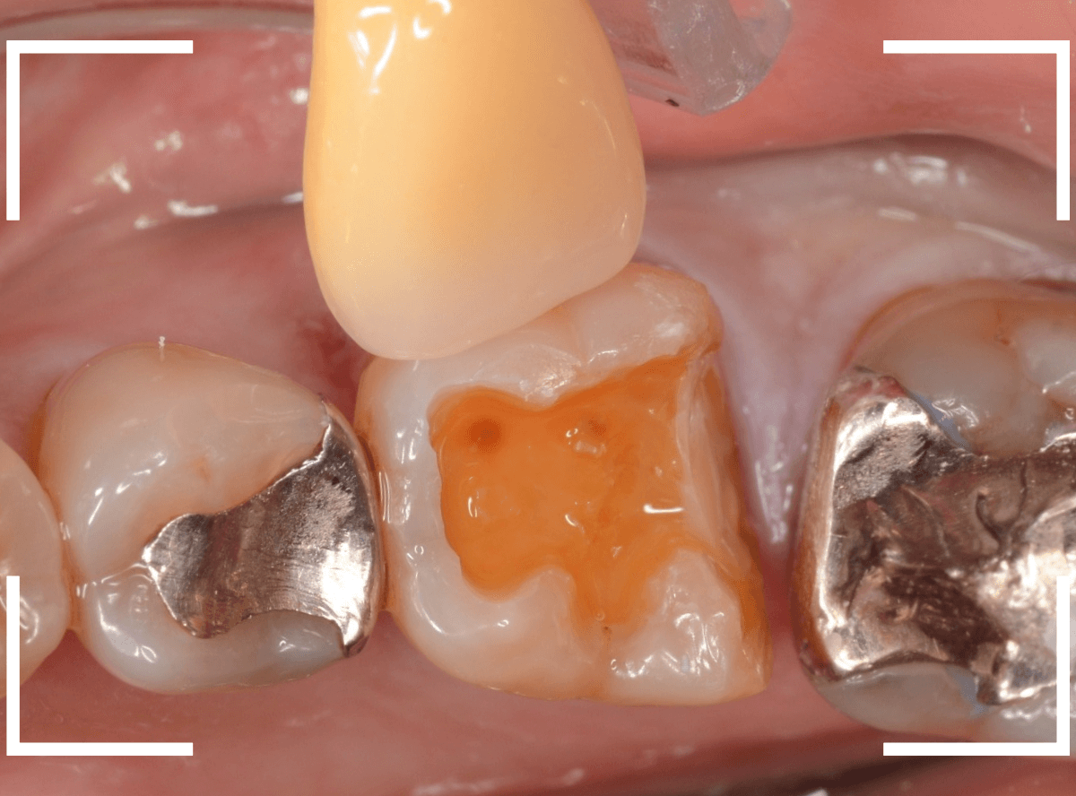 セラミック治療(インレー)17-4