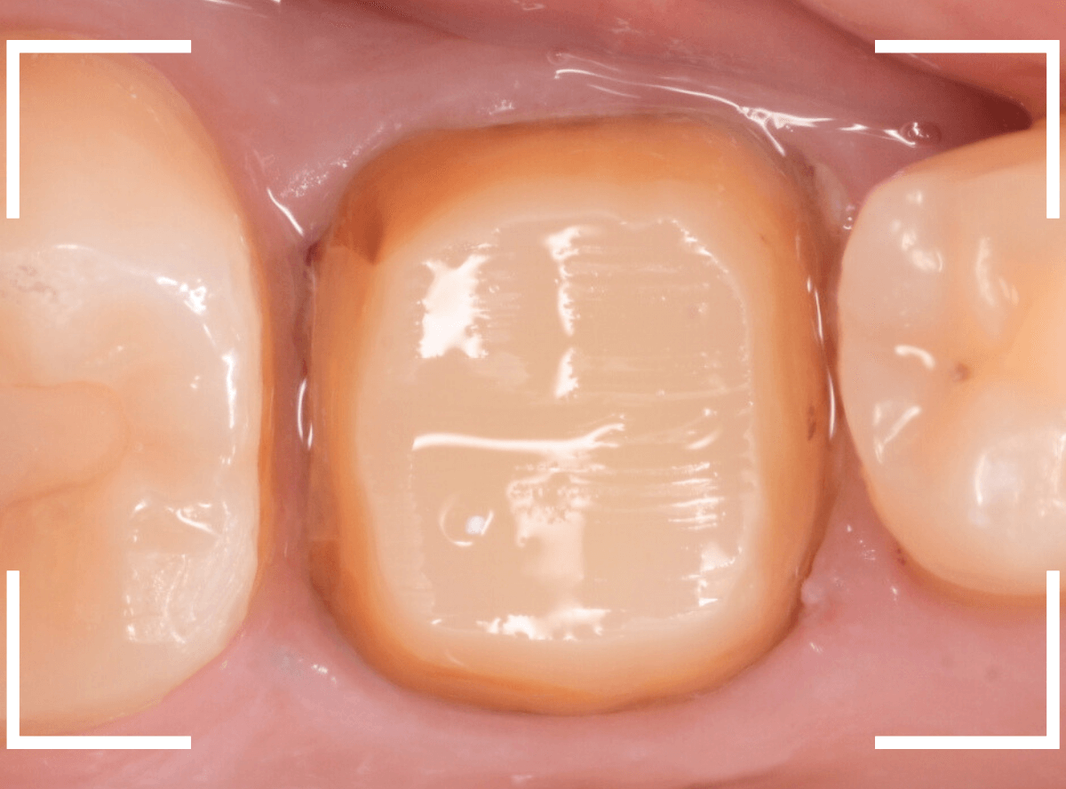 歯の土台の再治療1-5