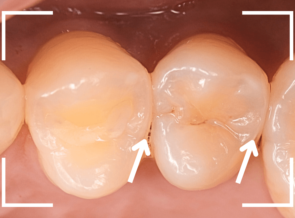 レントゲンでわかりづらい虫歯7-1