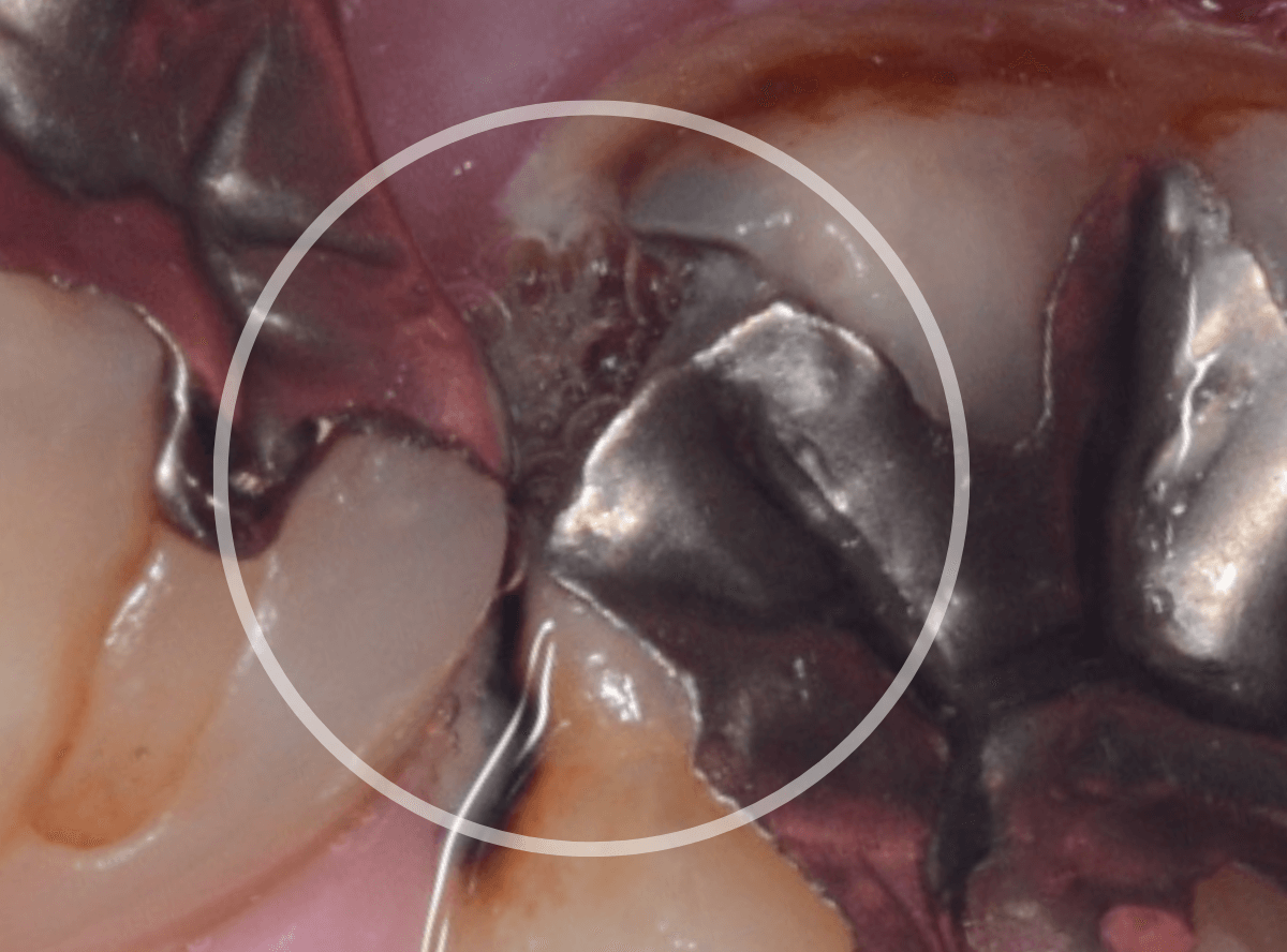 つめものの下の深い虫歯(画像)4-2