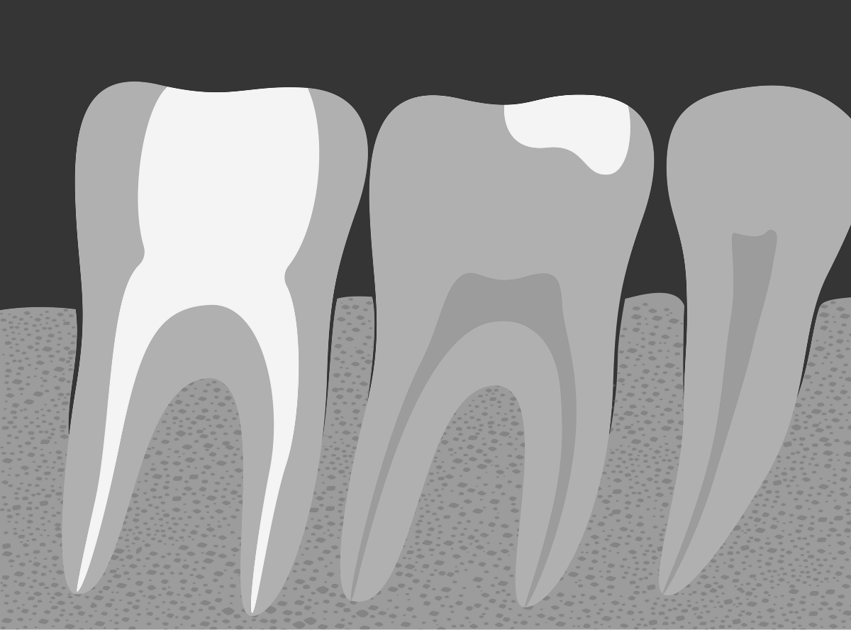 診断がつきづらい虫歯