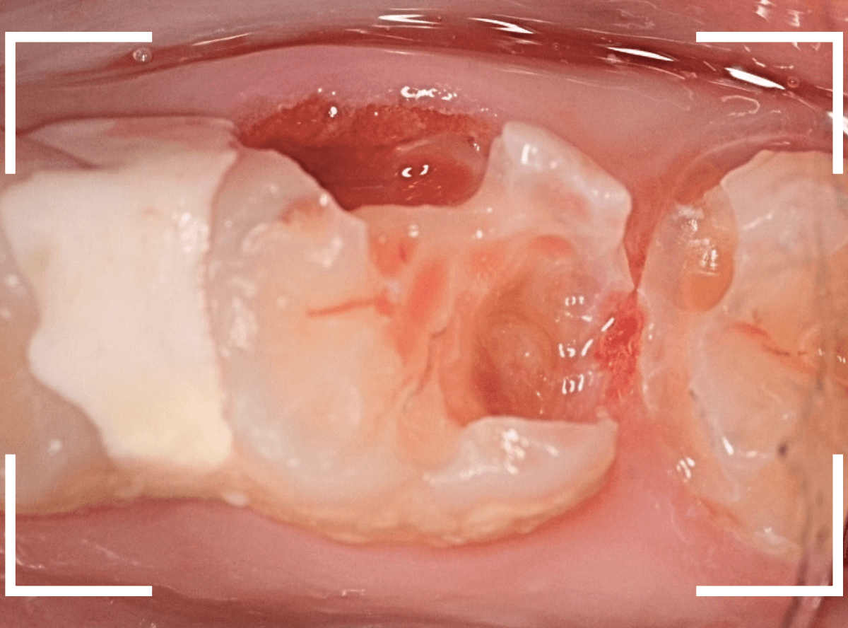 歯と歯の間の虫歯12-8