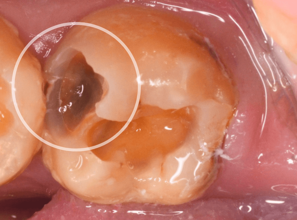 つめものの下の深い虫歯(画像)3-4