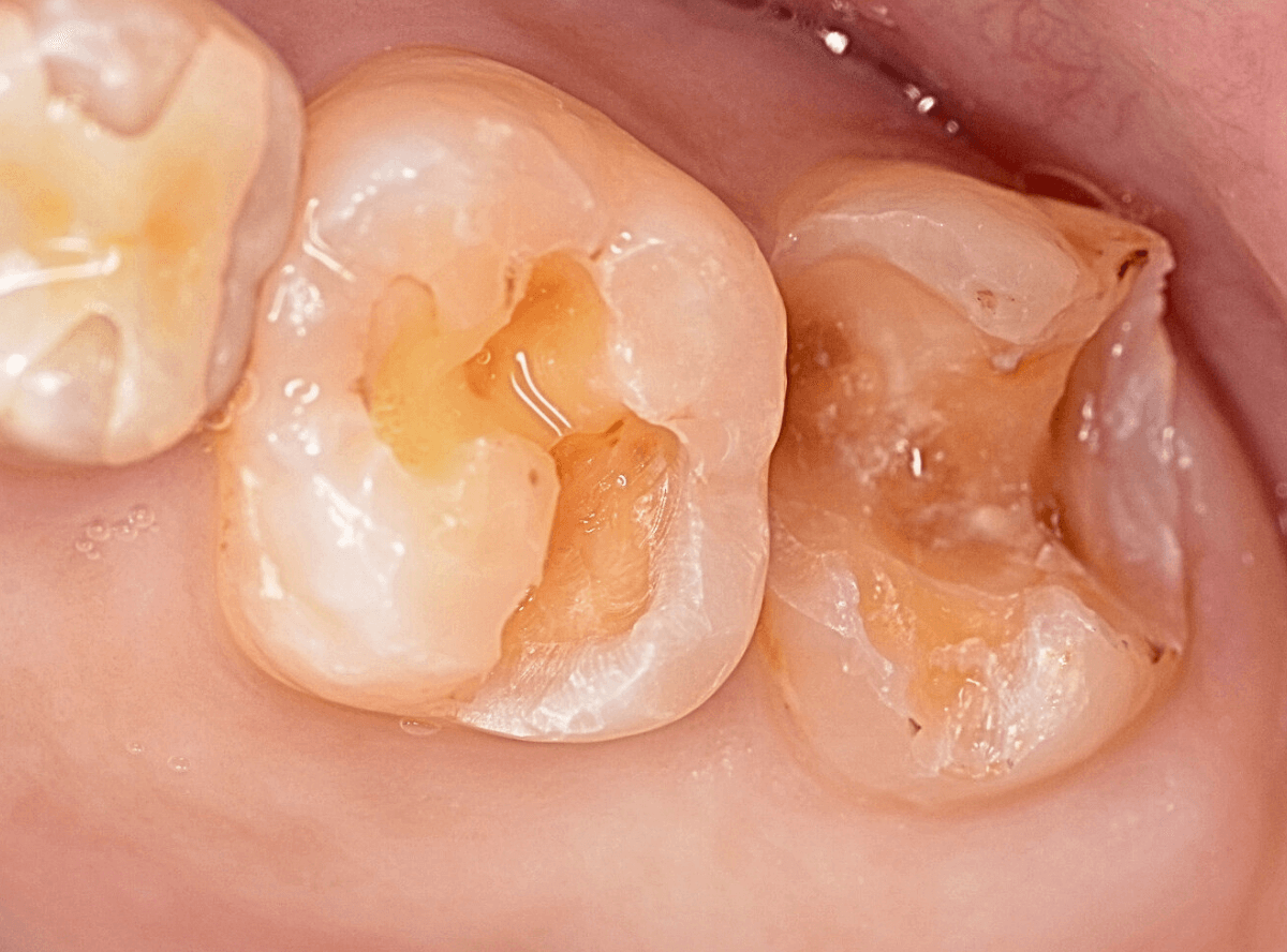 つめものの下の深い虫歯(画像)7-5