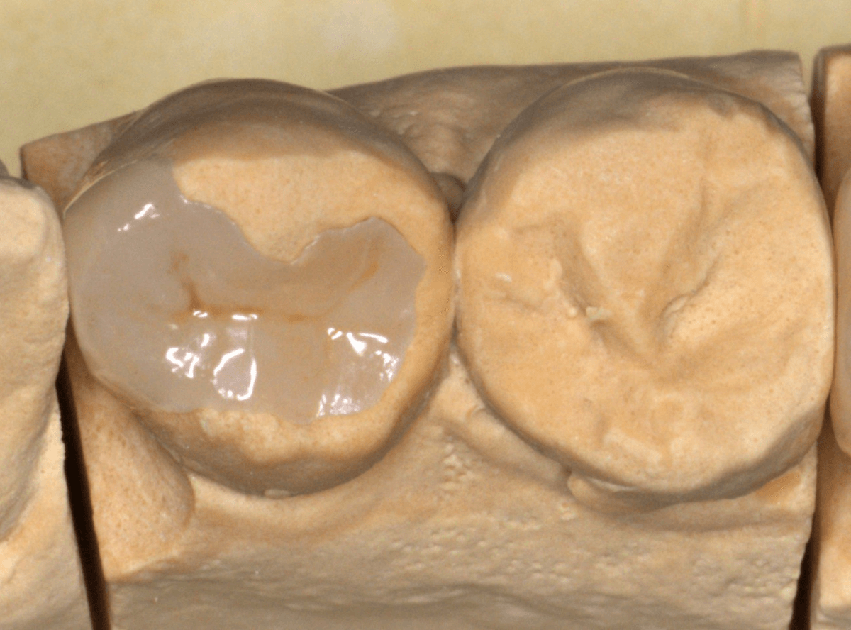 セラミック治療(インレー)13-3