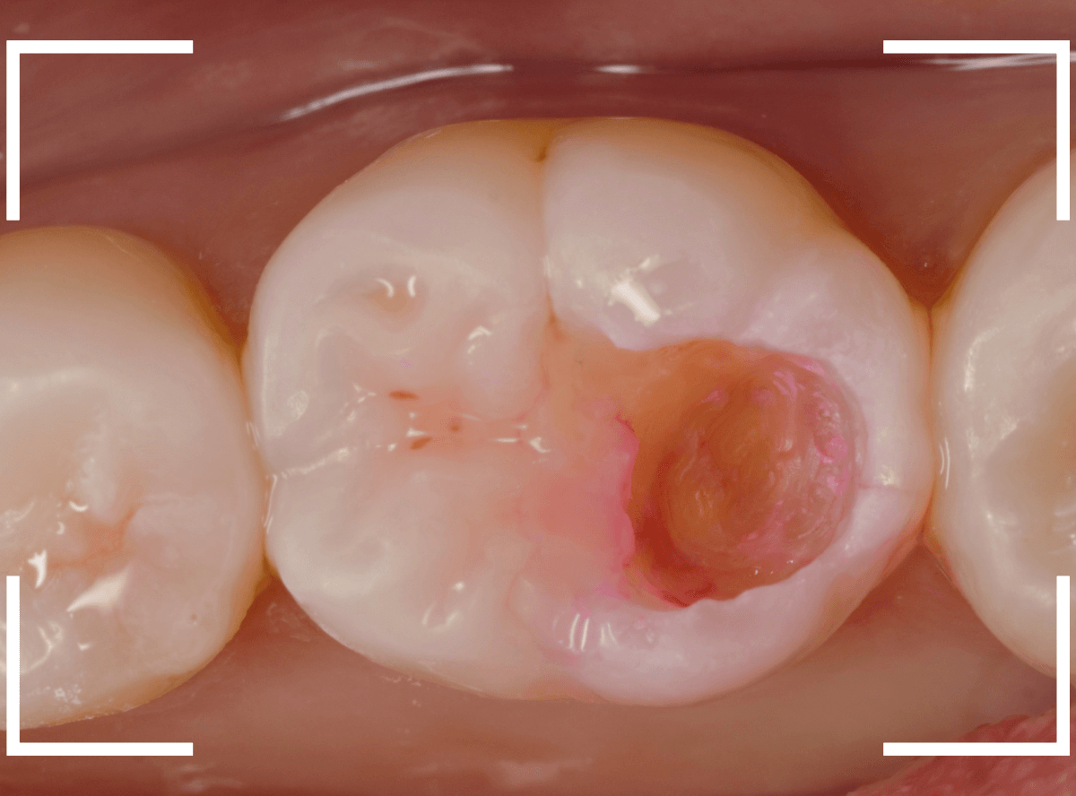 レントゲンでわかりづらい虫歯18-4