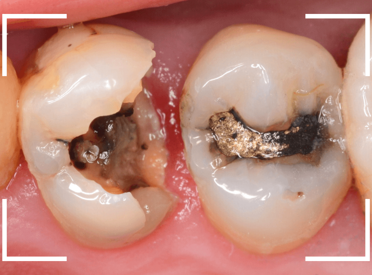 つめものの下の深い虫歯(画像)10-2