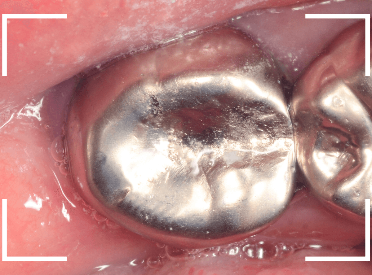 気づかないうちに深い虫歯14-1