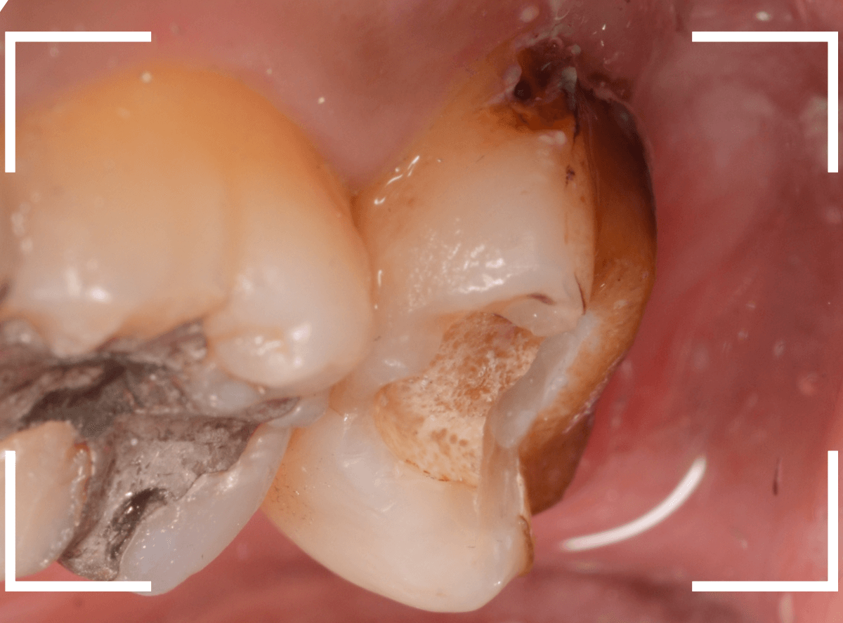 つめものの下の深い虫歯(画像)10-1