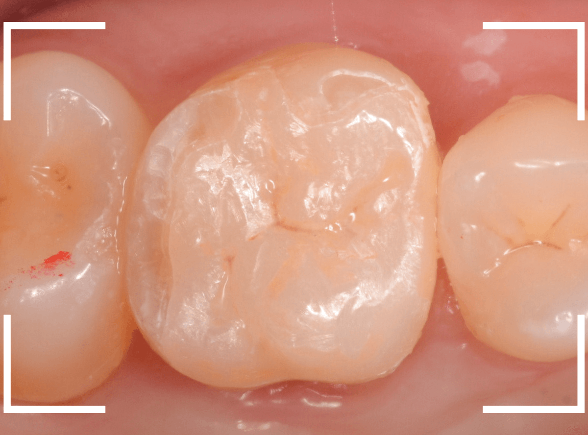 セラミック治療(インレー)19-5