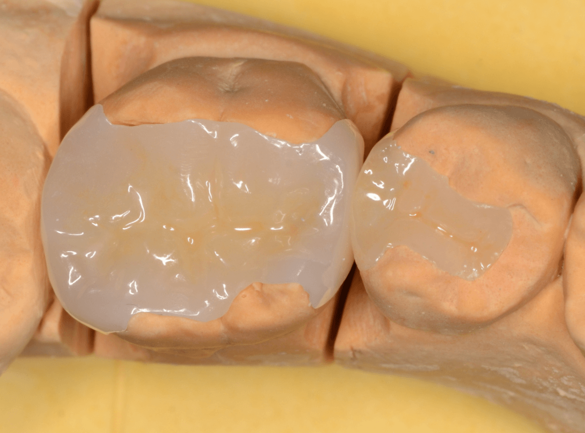 小窩裂溝う蝕1-8