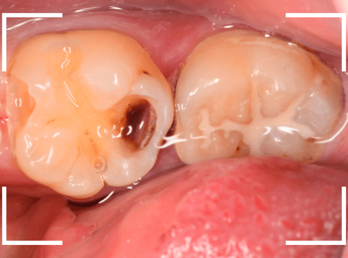 歯と歯の間の虫歯13-6