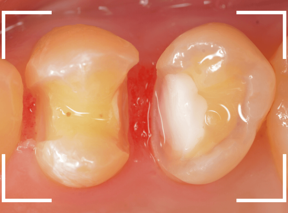 セラミック治療(インレー)28-2