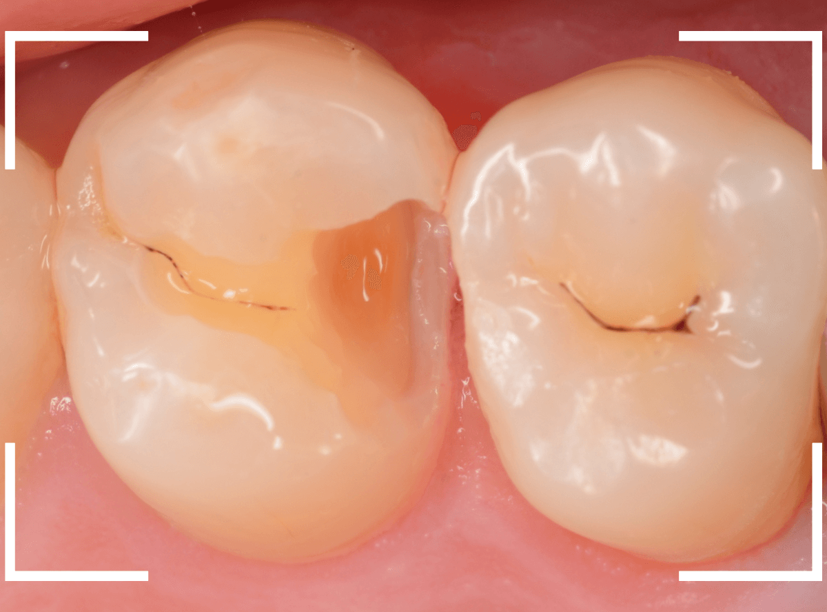 つめものの下の深い深い虫歯18-4