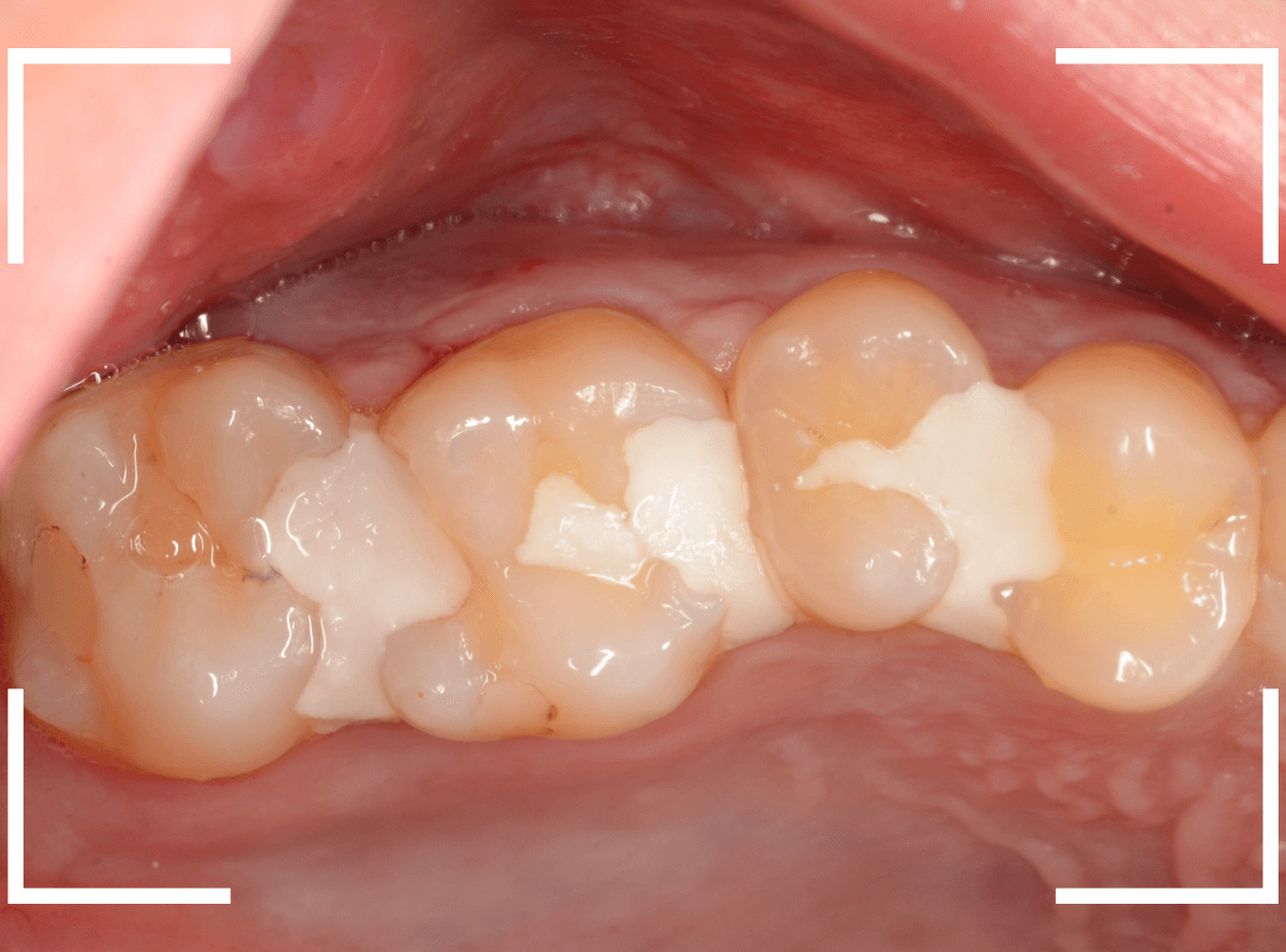 セラミック治療(インレー)34-1