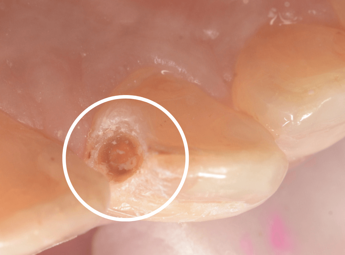 コンポジットレジン治療3-3