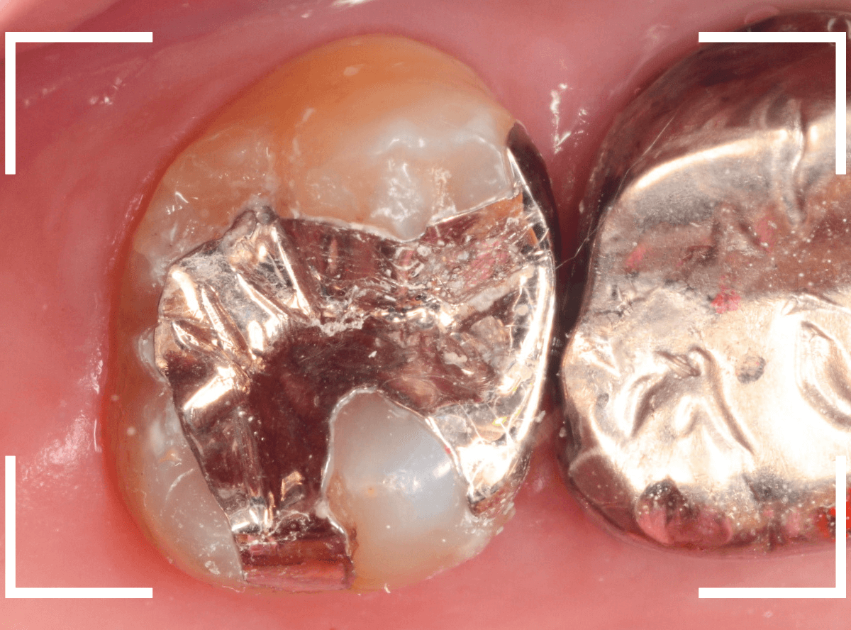 歯と歯の間の虫歯14-6