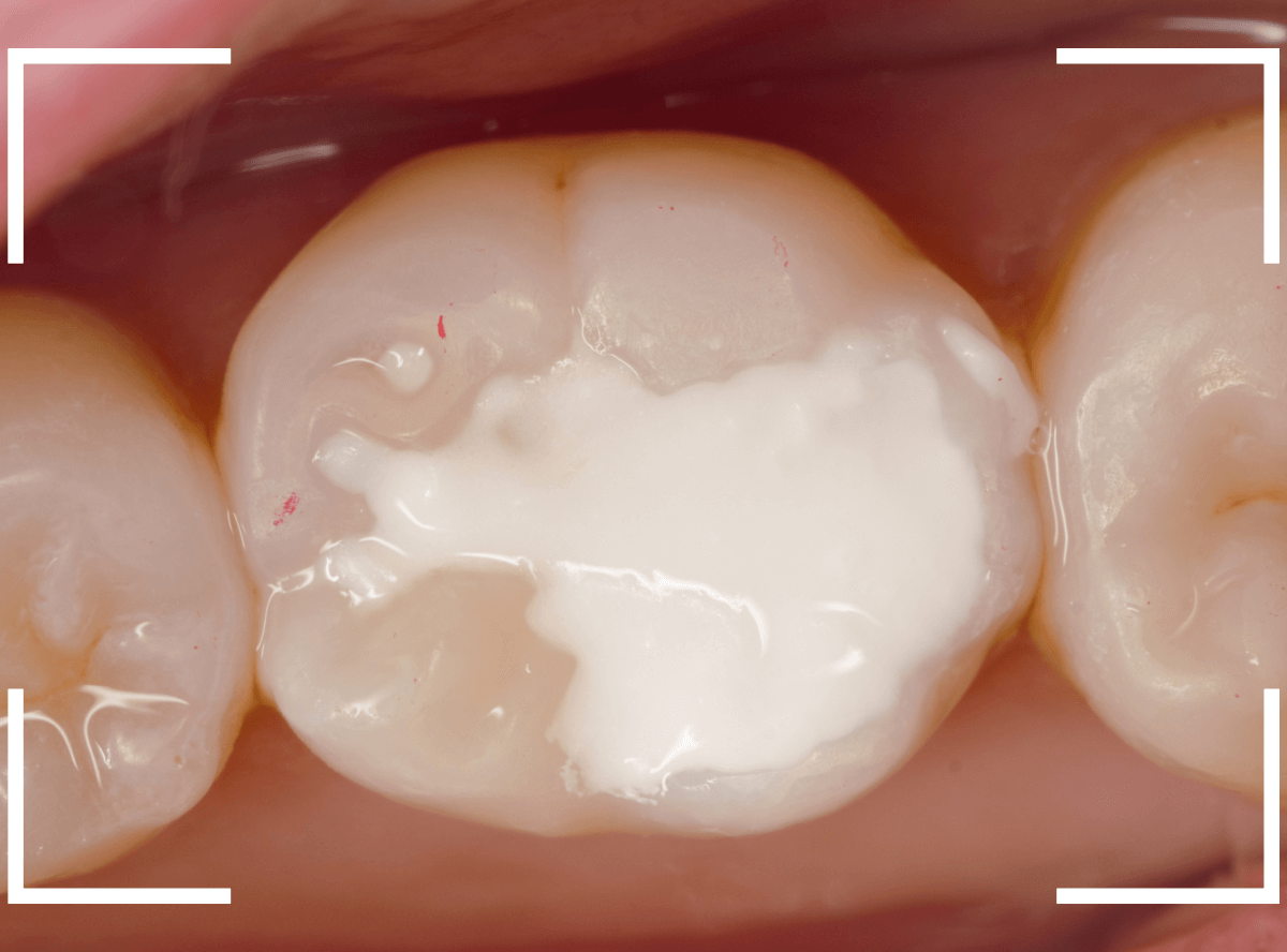 レントゲンでわかりづらい虫歯18-6