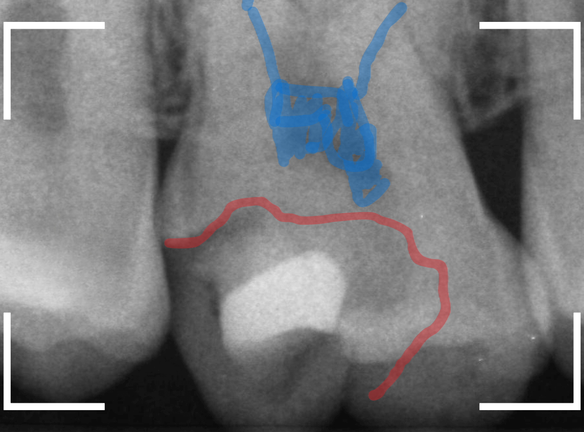 つめものの下の深い深い虫歯20-1