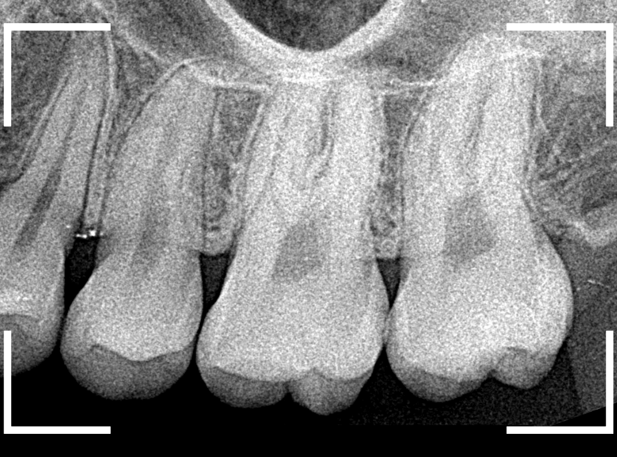 レントゲンでわかりづらい虫歯8-2