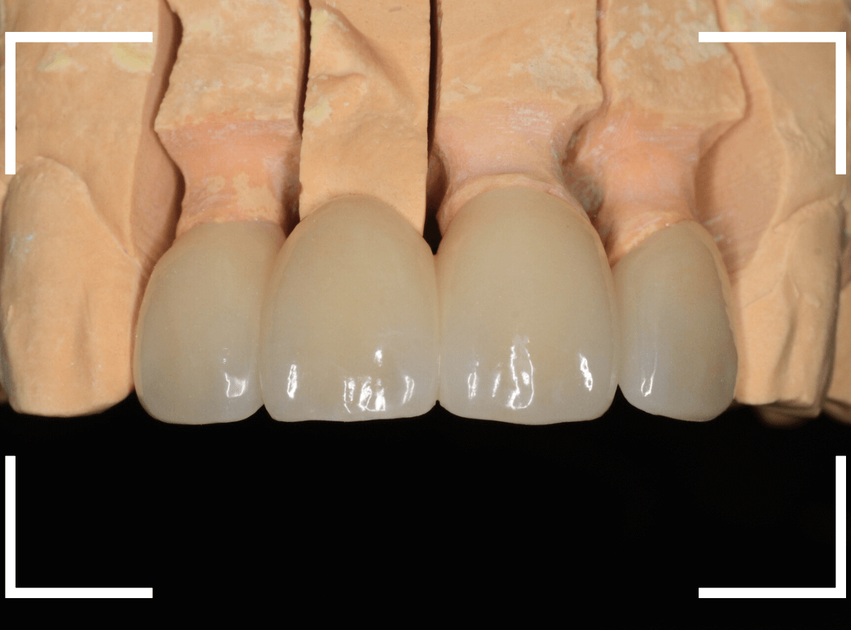 セラミック治療(前歯・クラウン)4-5