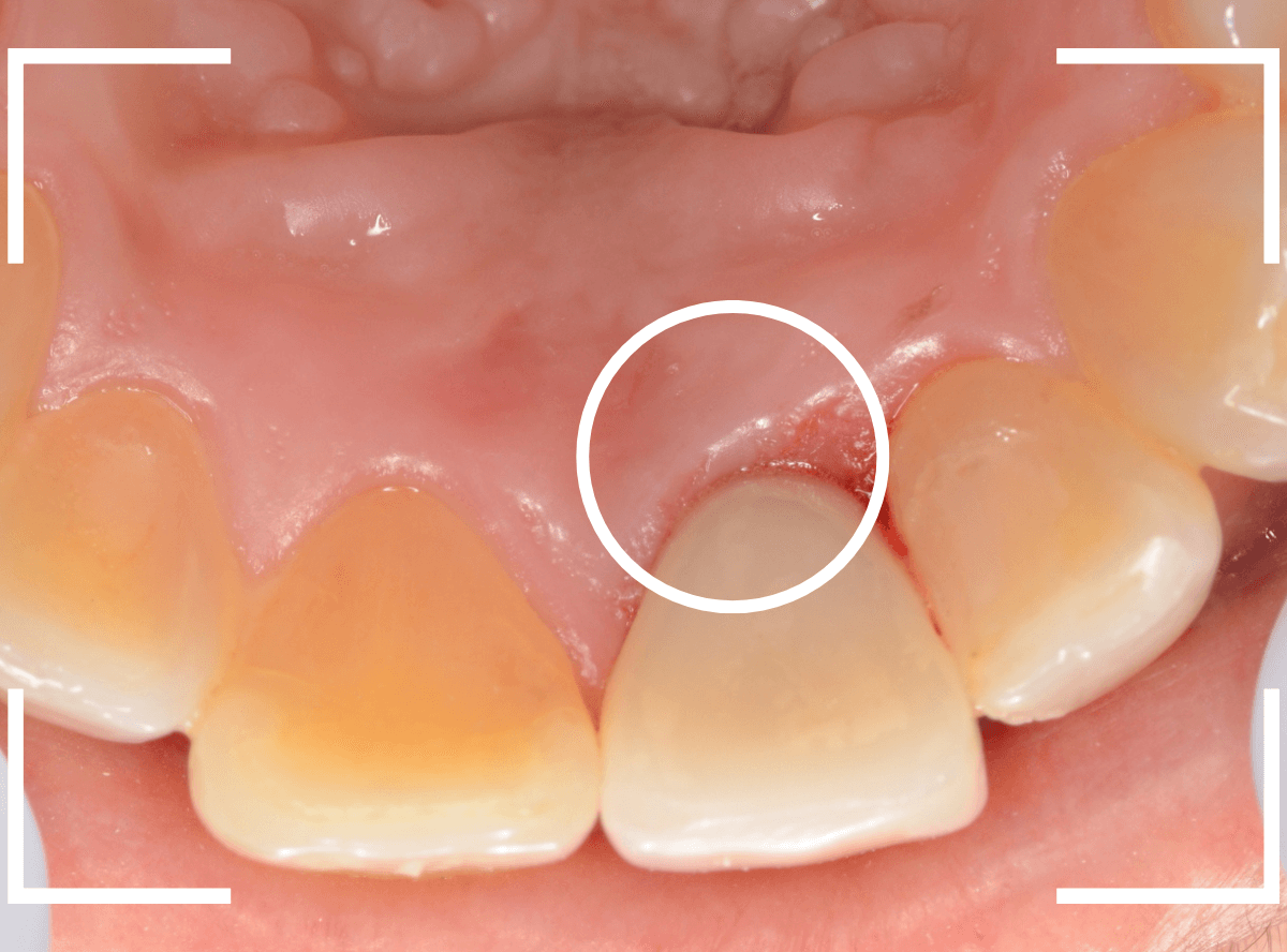 セラミック治療(前歯・クラウン)3-11