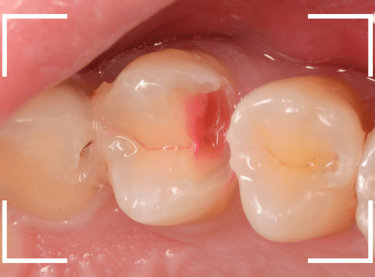 歯と歯の間の虫歯16-5