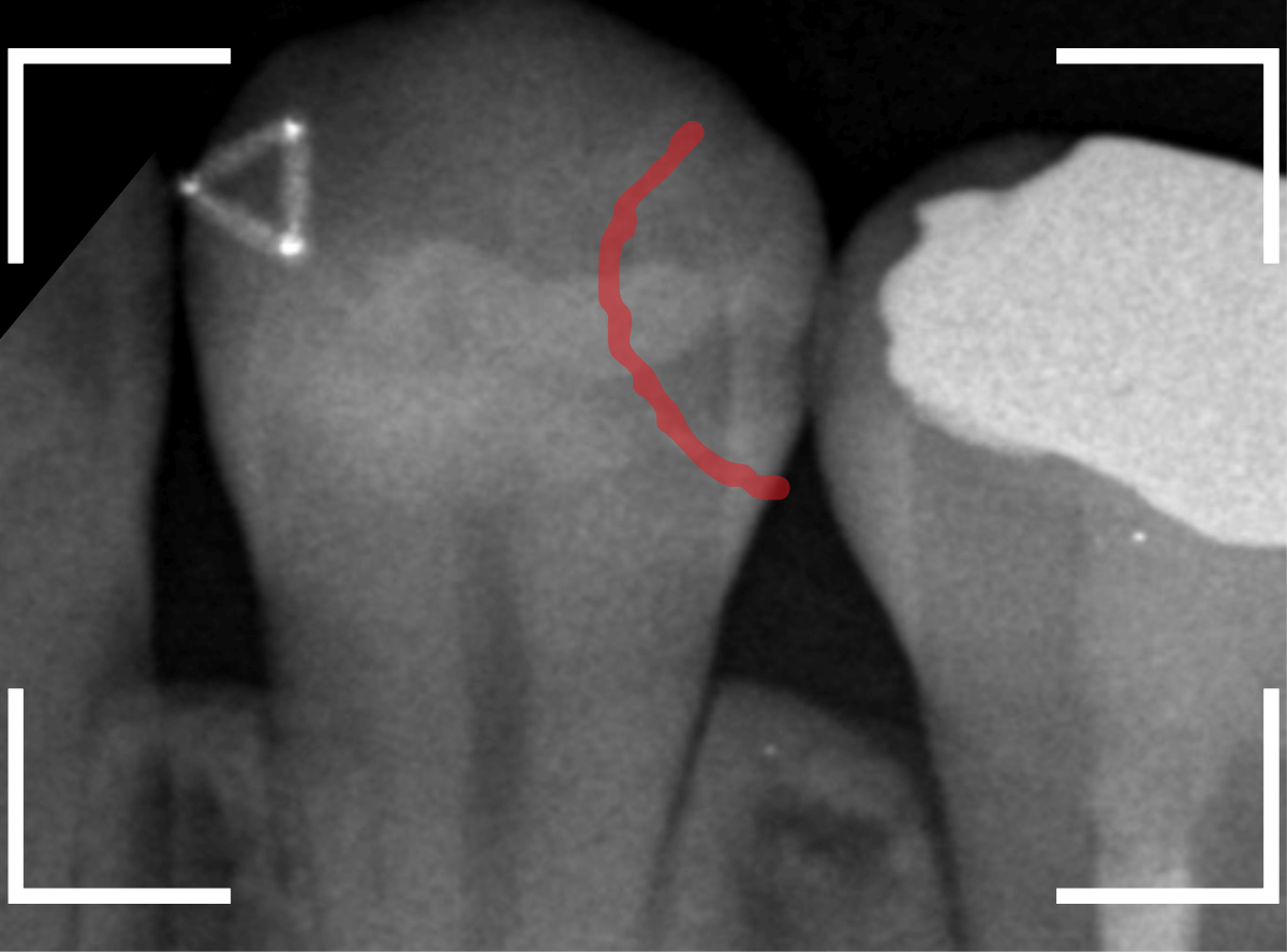 歯と歯の間の虫歯6-1