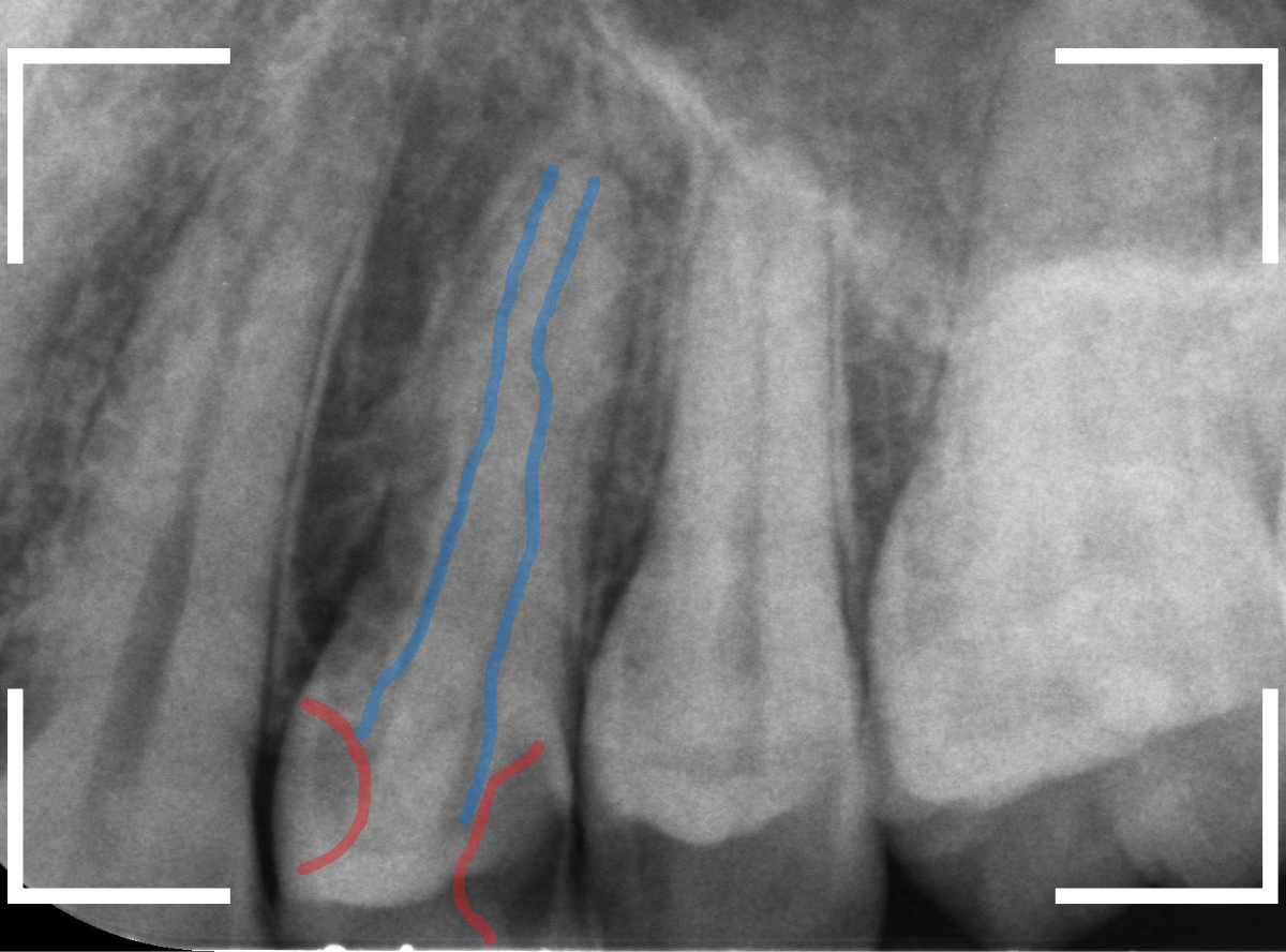 歯と歯の間の虫歯19-2