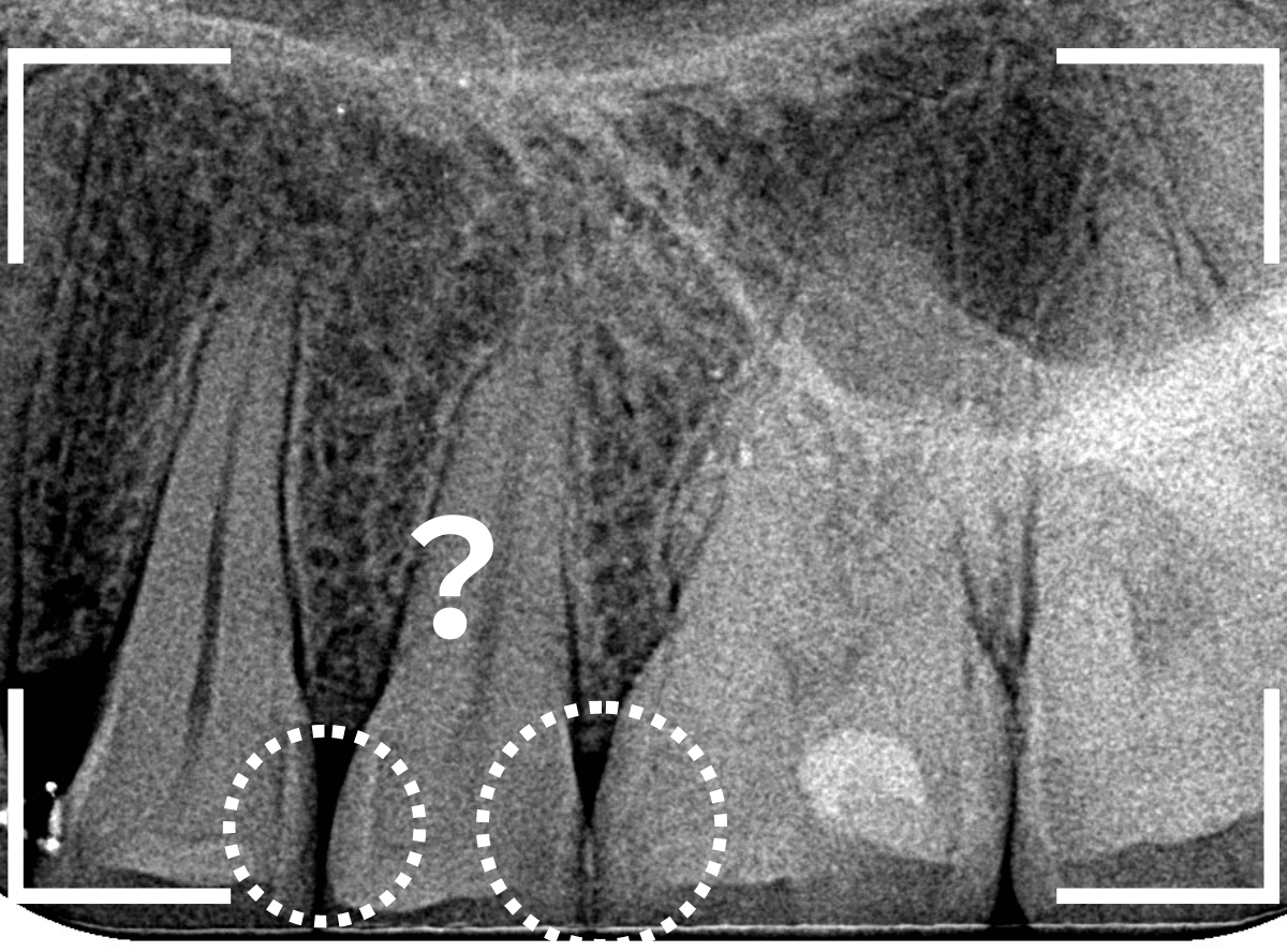 レントゲンでわかりづらい虫歯7-2