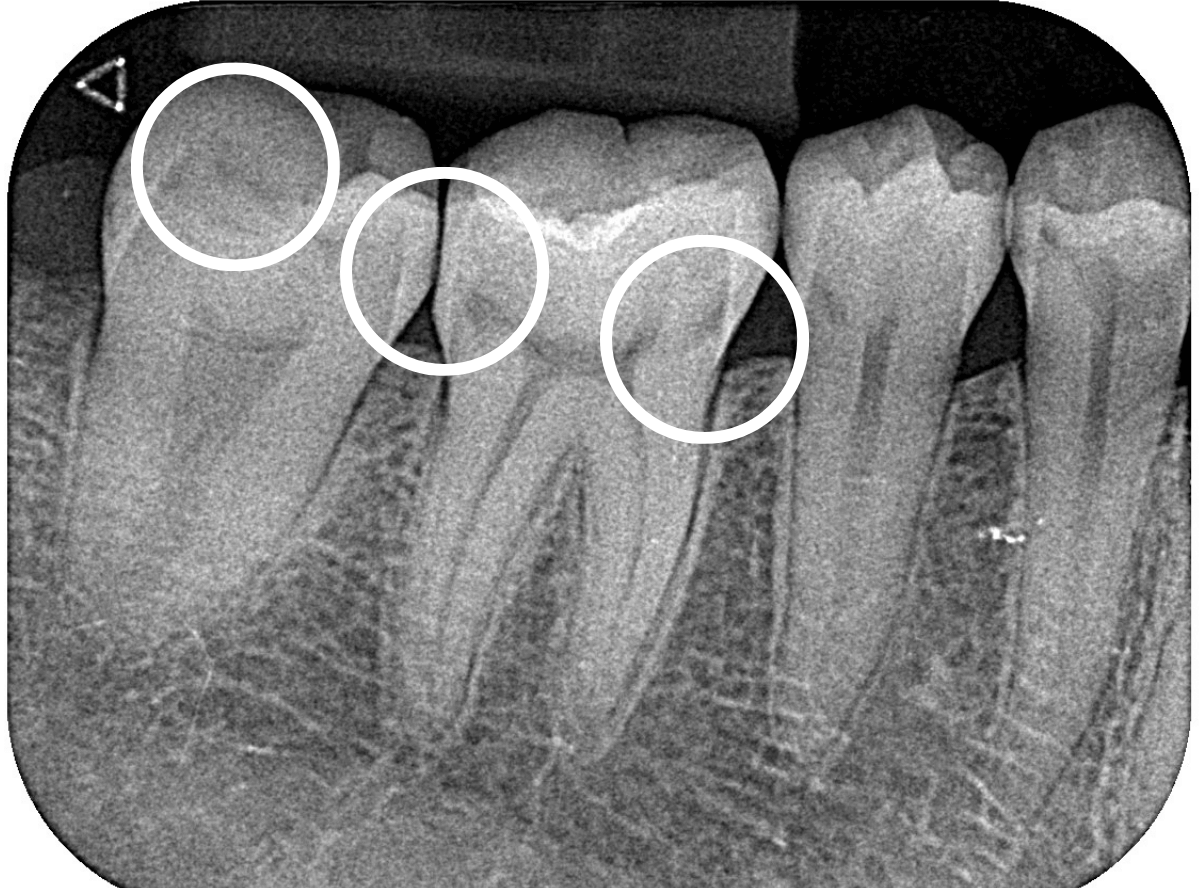 つめものの下の深い深い虫歯11-1