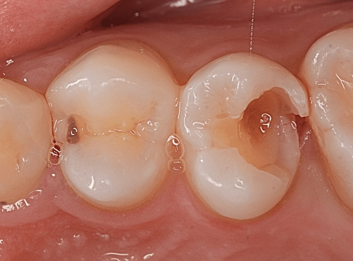つめものの下の深い深い虫歯11-1