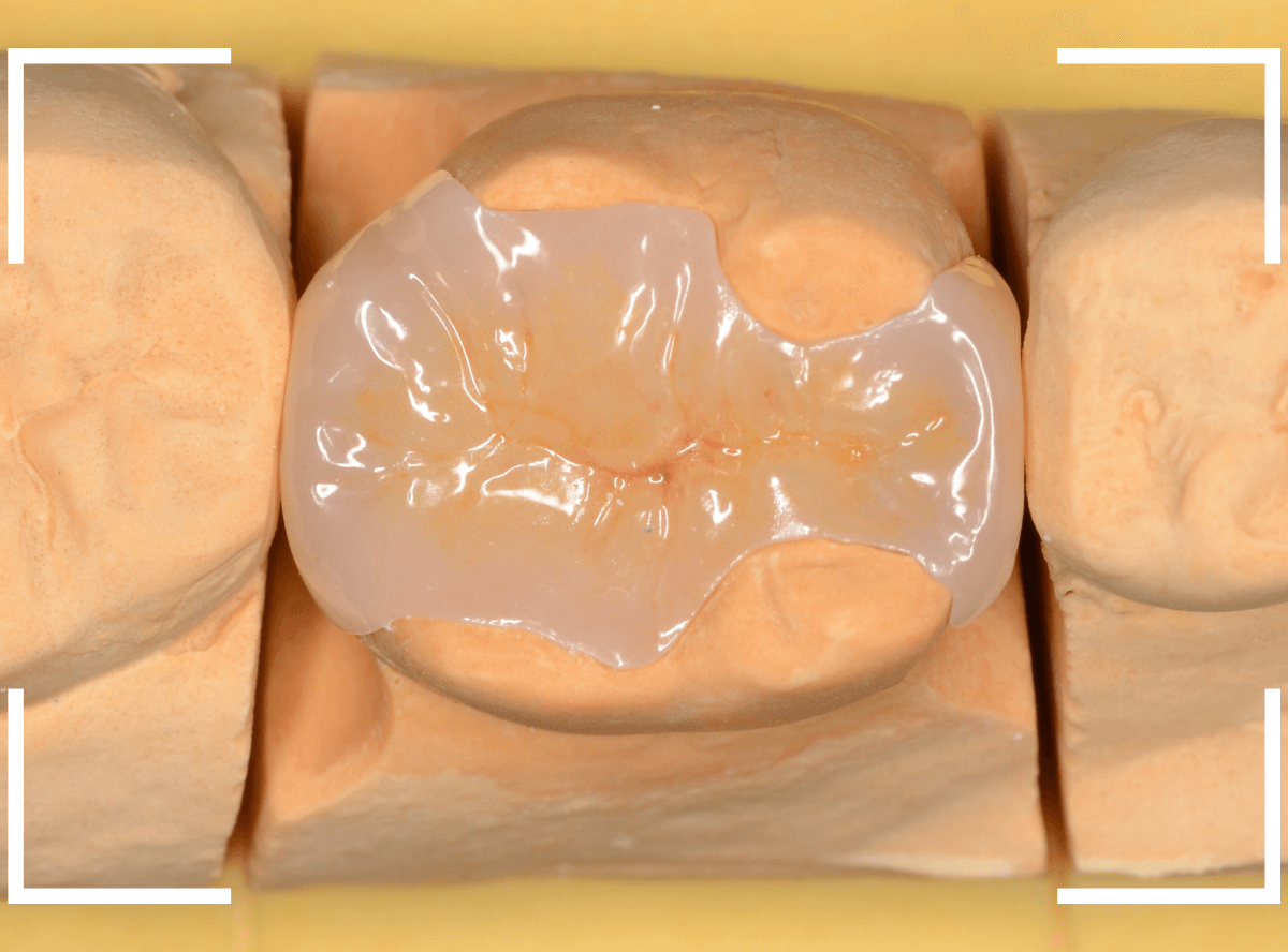 セラミック治療(インレー)29-3