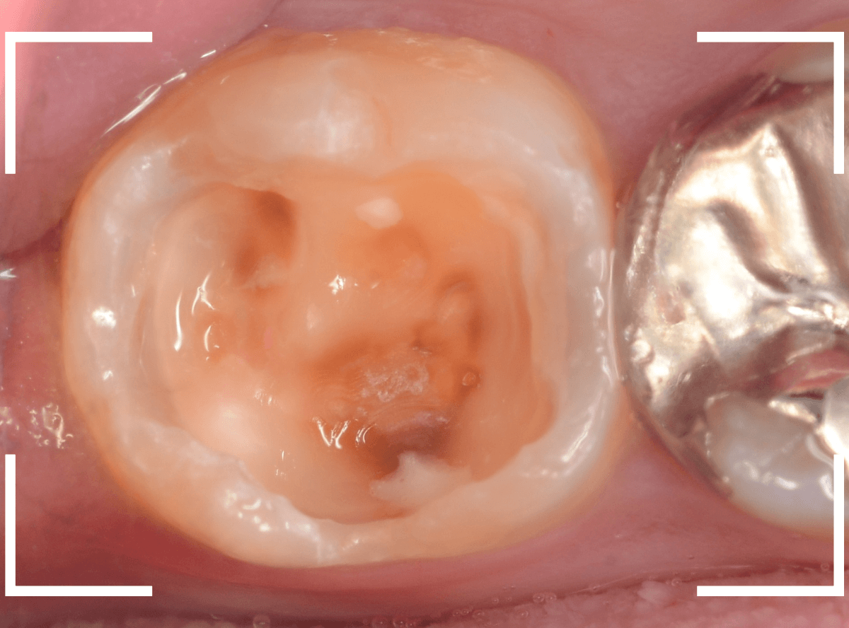 気づかないうちに深い虫歯13-3