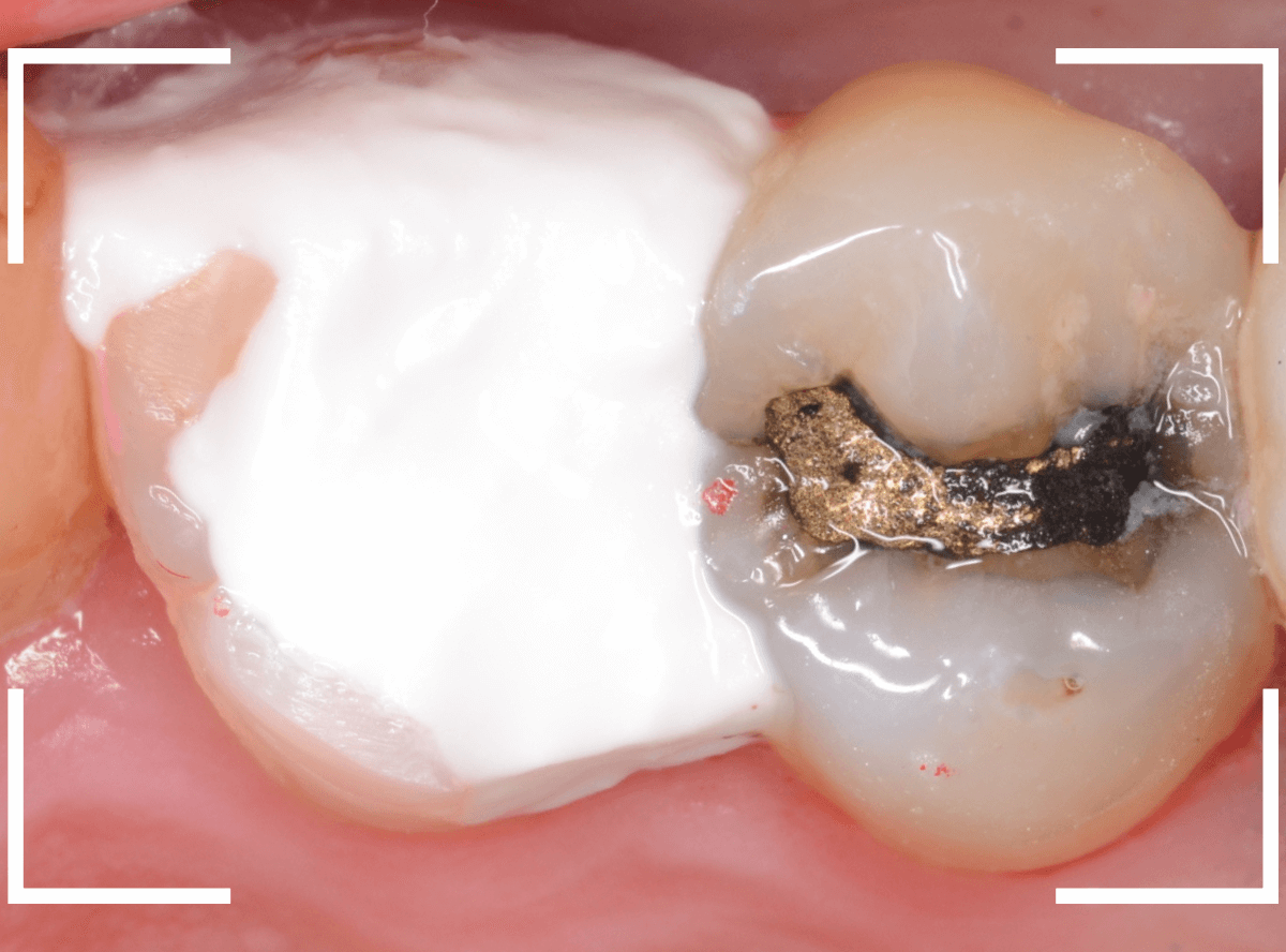 つめものの下の深い虫歯(画像)10-4