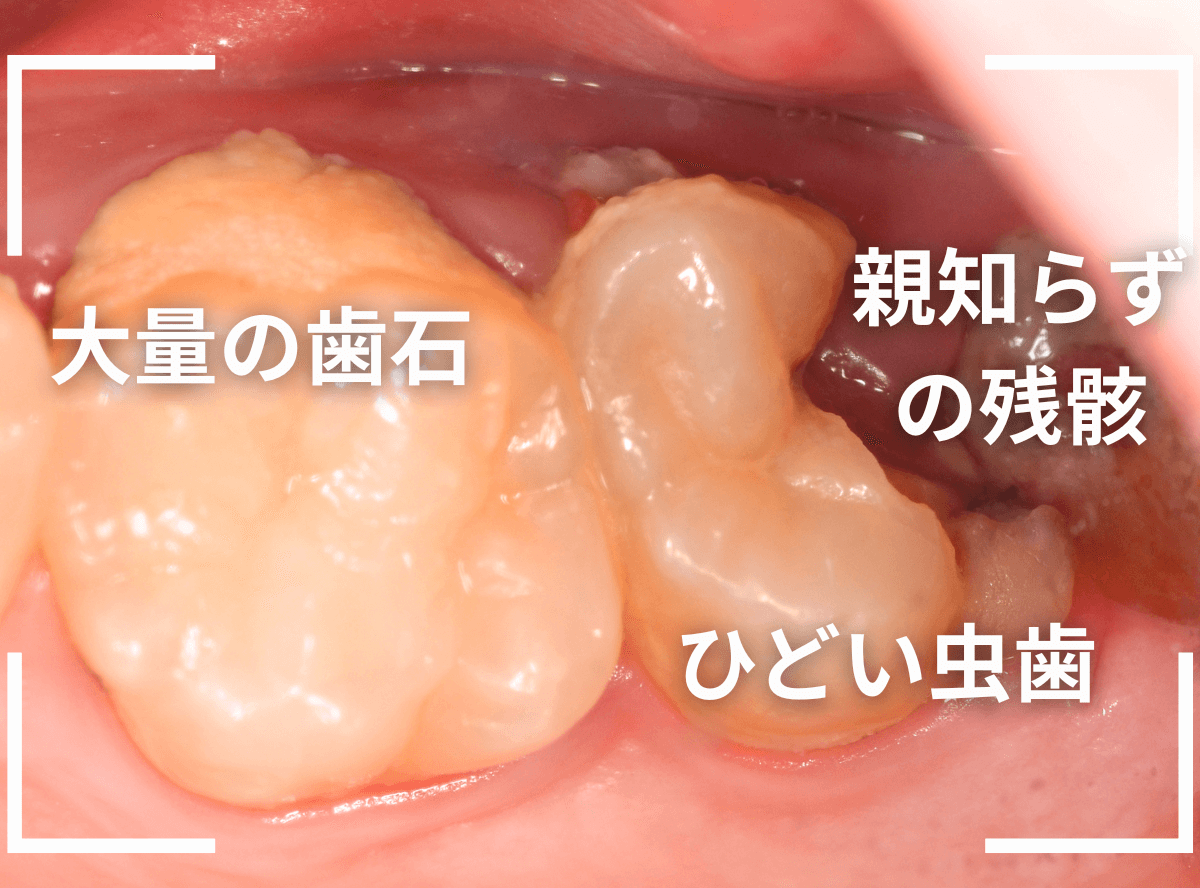 虫歯を放置して、抜歯7-2