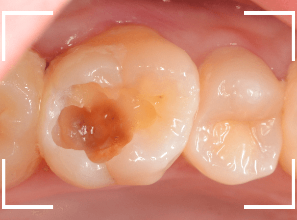 セラミック治療(インレー)32-4