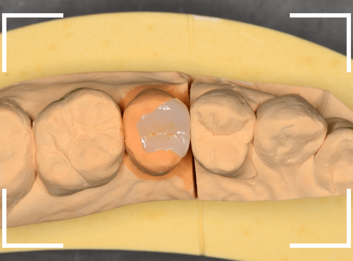 セラミック治療(インレー)27-7