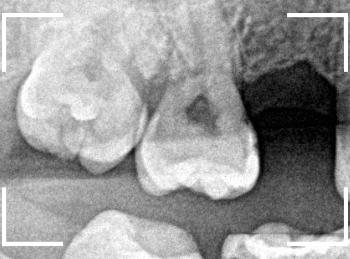 おやしらずの抜歯13-2